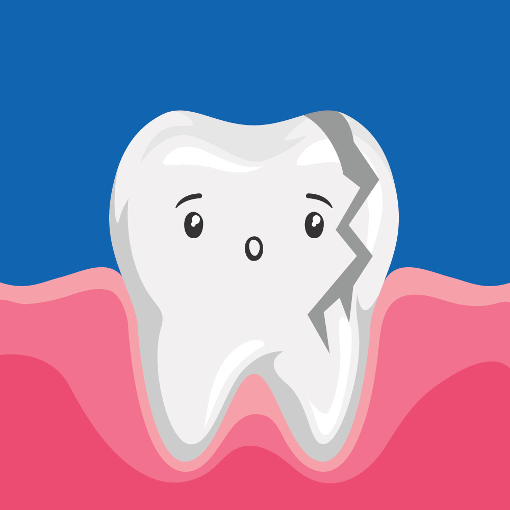 Cartoon of cracked tooth, Emergency Dentistry, Waterloo, ON